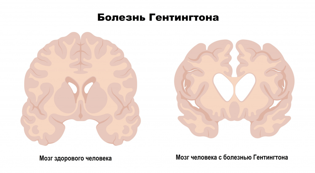 Атрофия мозга при болезни Хантингтона, вызванная накоплением мутантного белка хантингтина. Генная терапия AMT-130 нацелена на снижение выработки этого токсичного белка для замедления прогрессирования заболевания.